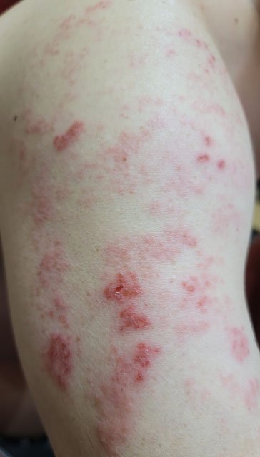 腕に痛そうな帯状疱疹が出ている写真（写真はphotoACより）