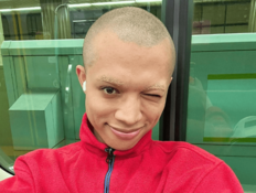 「3秒でとった」TikTokフォロワー100万人超えのロイ、顔のほくろを除去した理由が想定外！